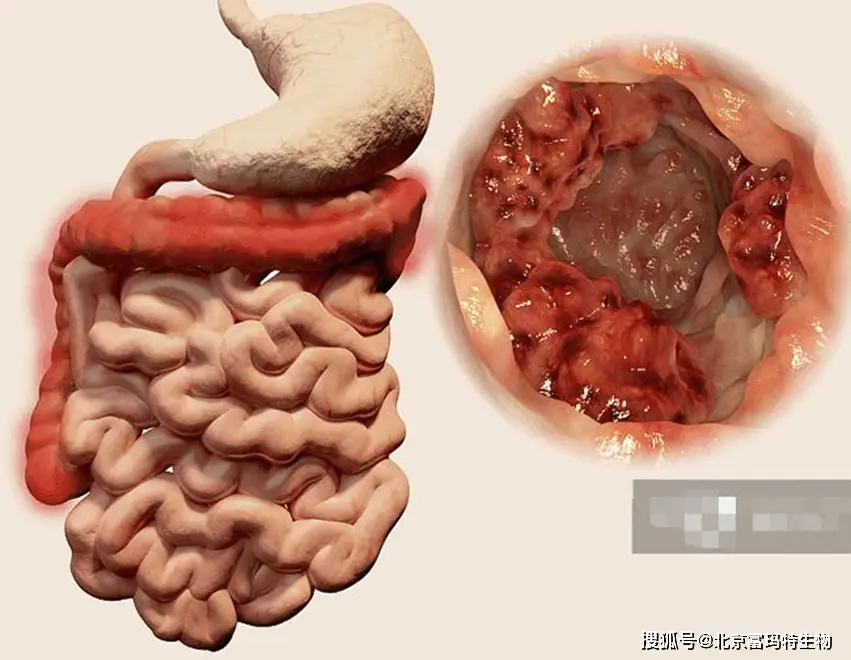 克罗恩大便的特点_克罗恩肠炎的大便症状_肠炎克罗恩