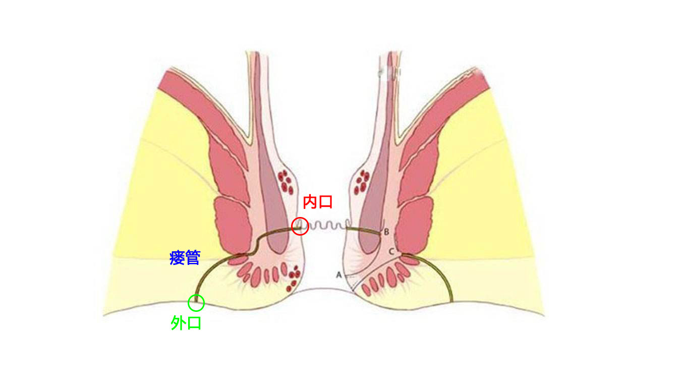 手术肛瘘时间多长_肛瘘手术时间多久_手术肛瘘时间长吗