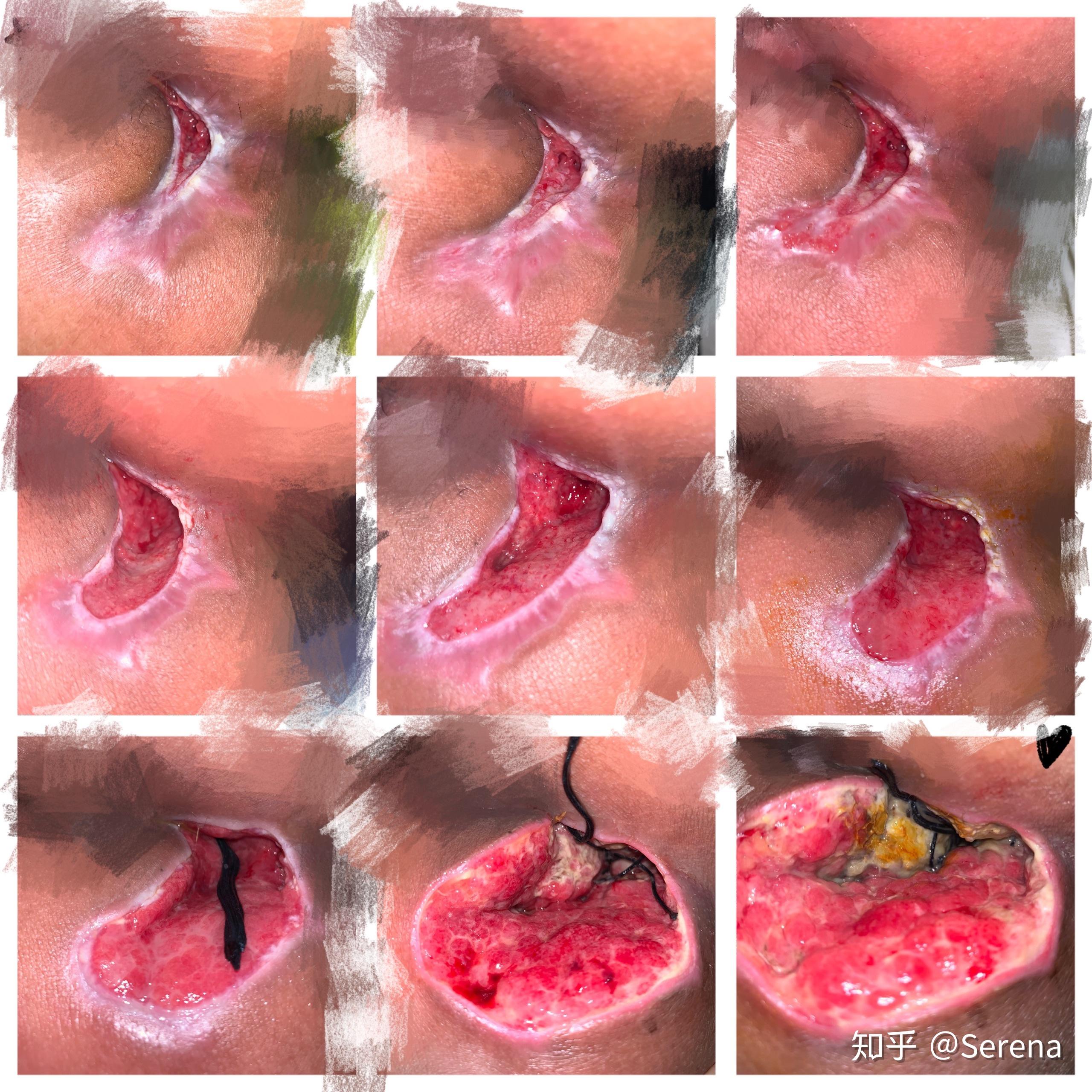 肛瘘手术时间多久_手术肛瘘时间长吗_手术肛瘘时间多长