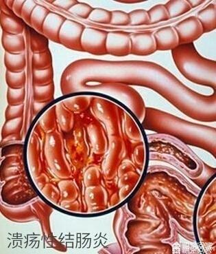 大便出鲜血是怎么回事-大便出鲜血原因大揭秘，这些你一定要知道