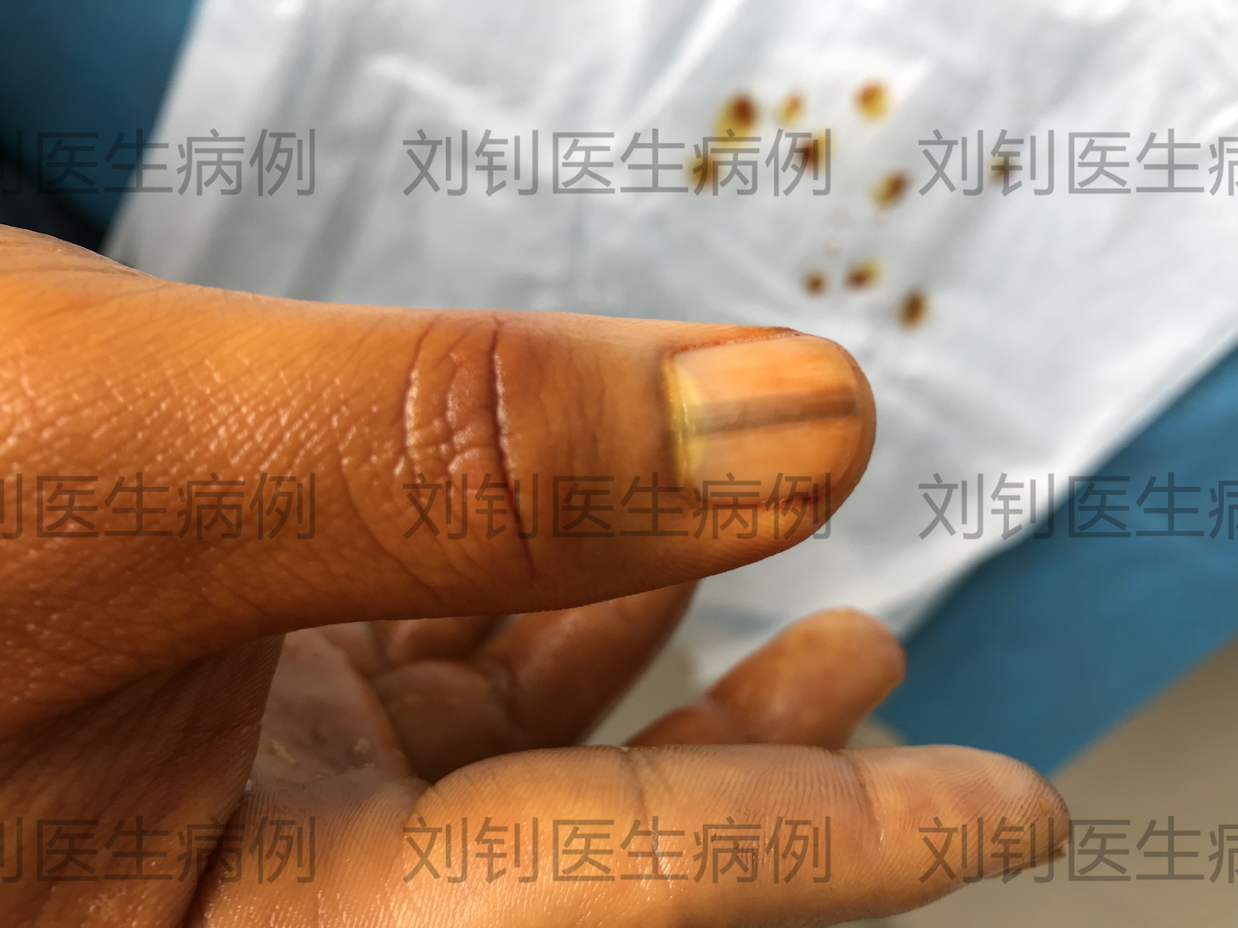取病例需要本人吗_去医院取病例需要什么_病例取医院需要去医院吗