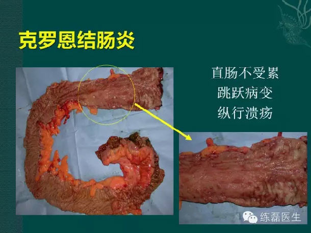 药物病治疗罗恩克菌的原理_克罗恩病的药物治疗_罗克罗恩病